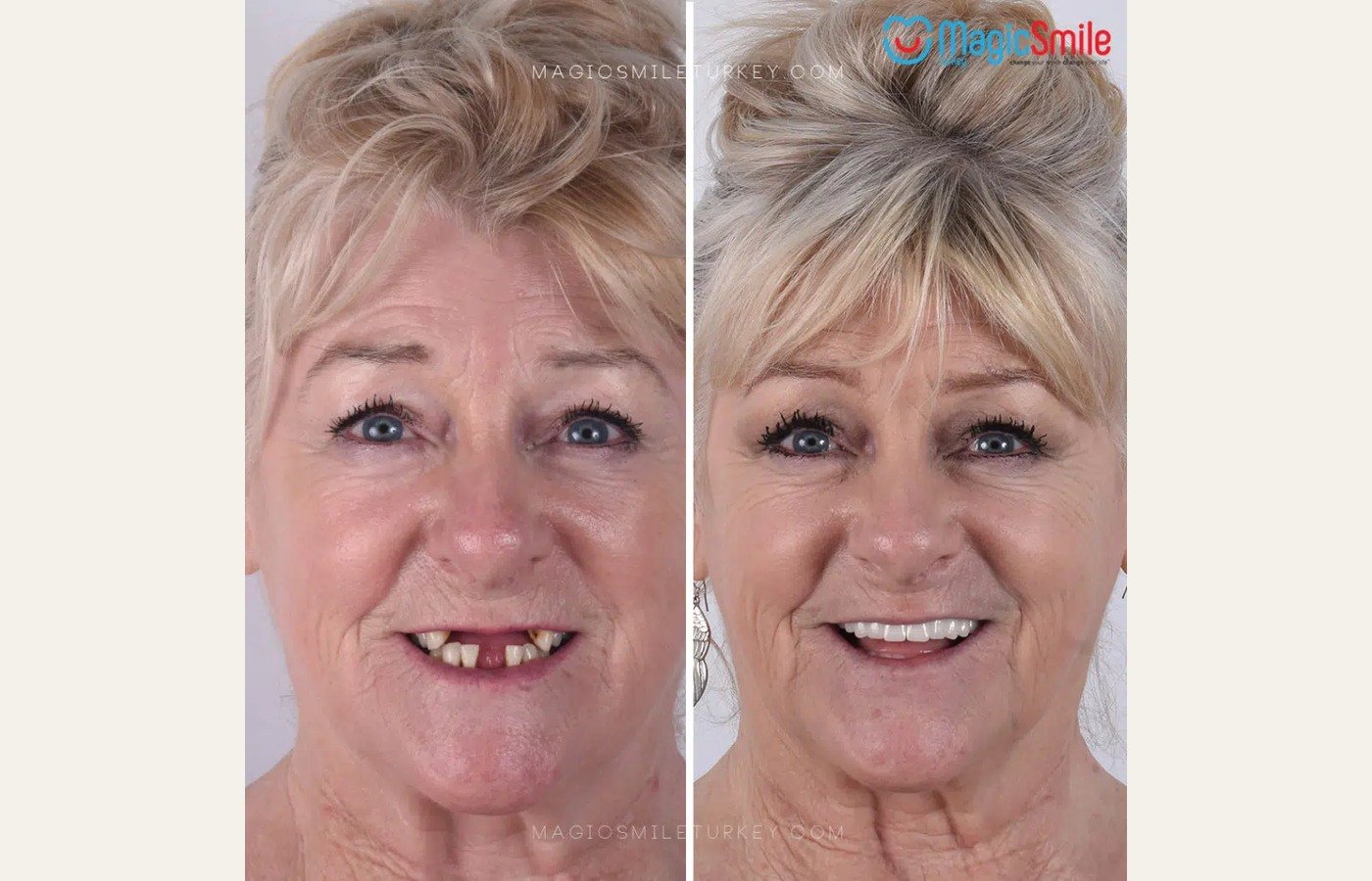 Before After 1