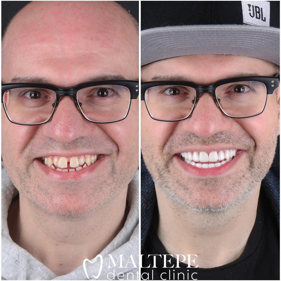Before After 1