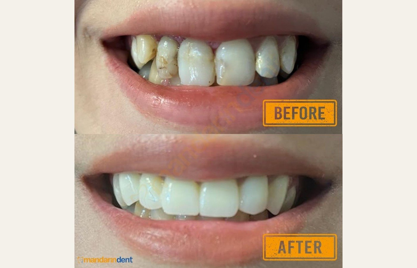 Before After 1