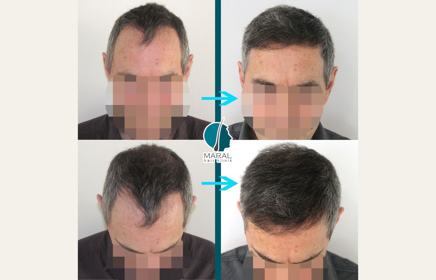 Before After 1