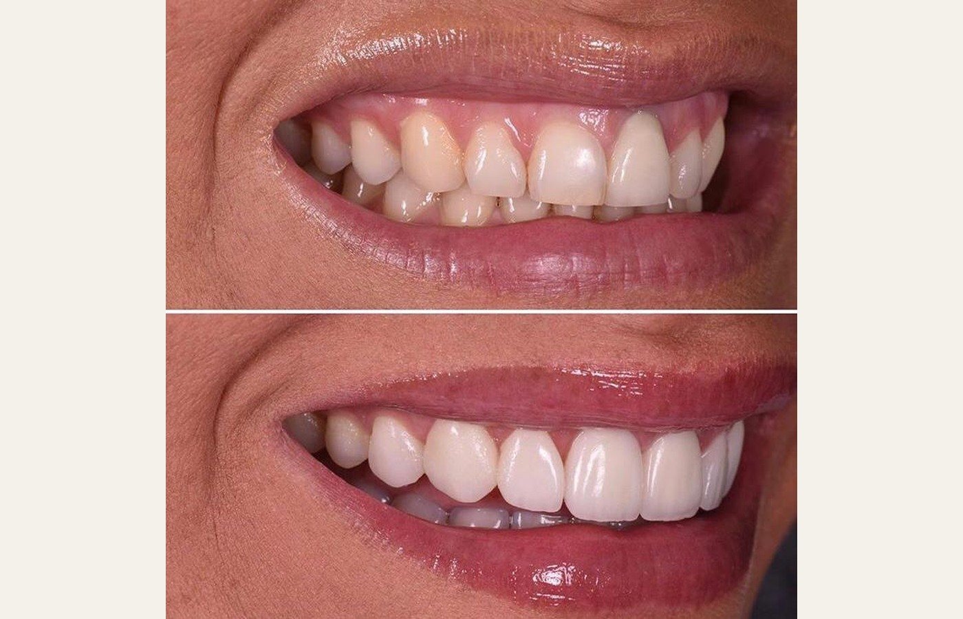 Before After 1