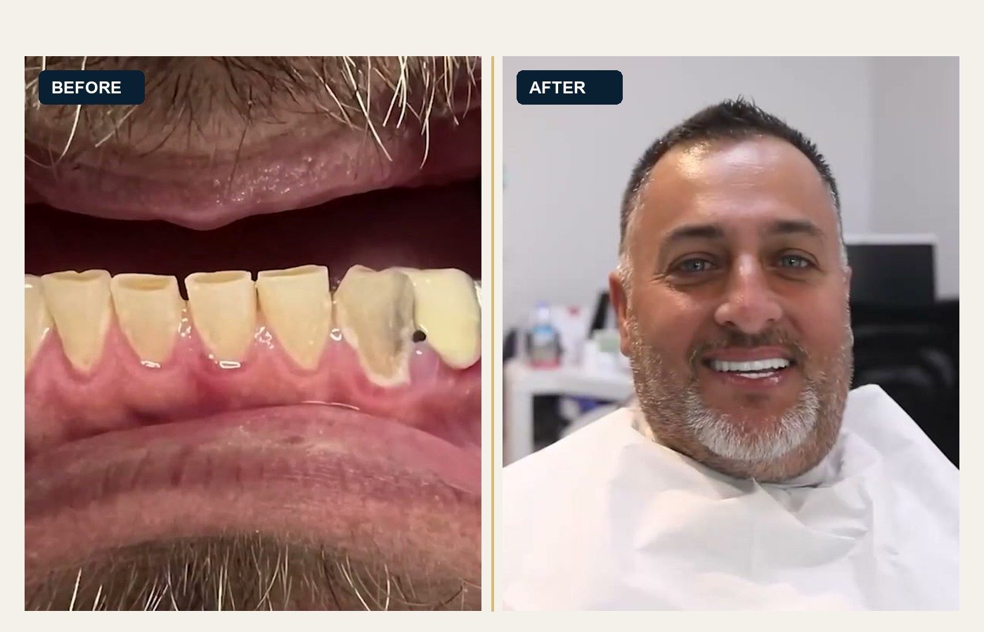 Before After 1