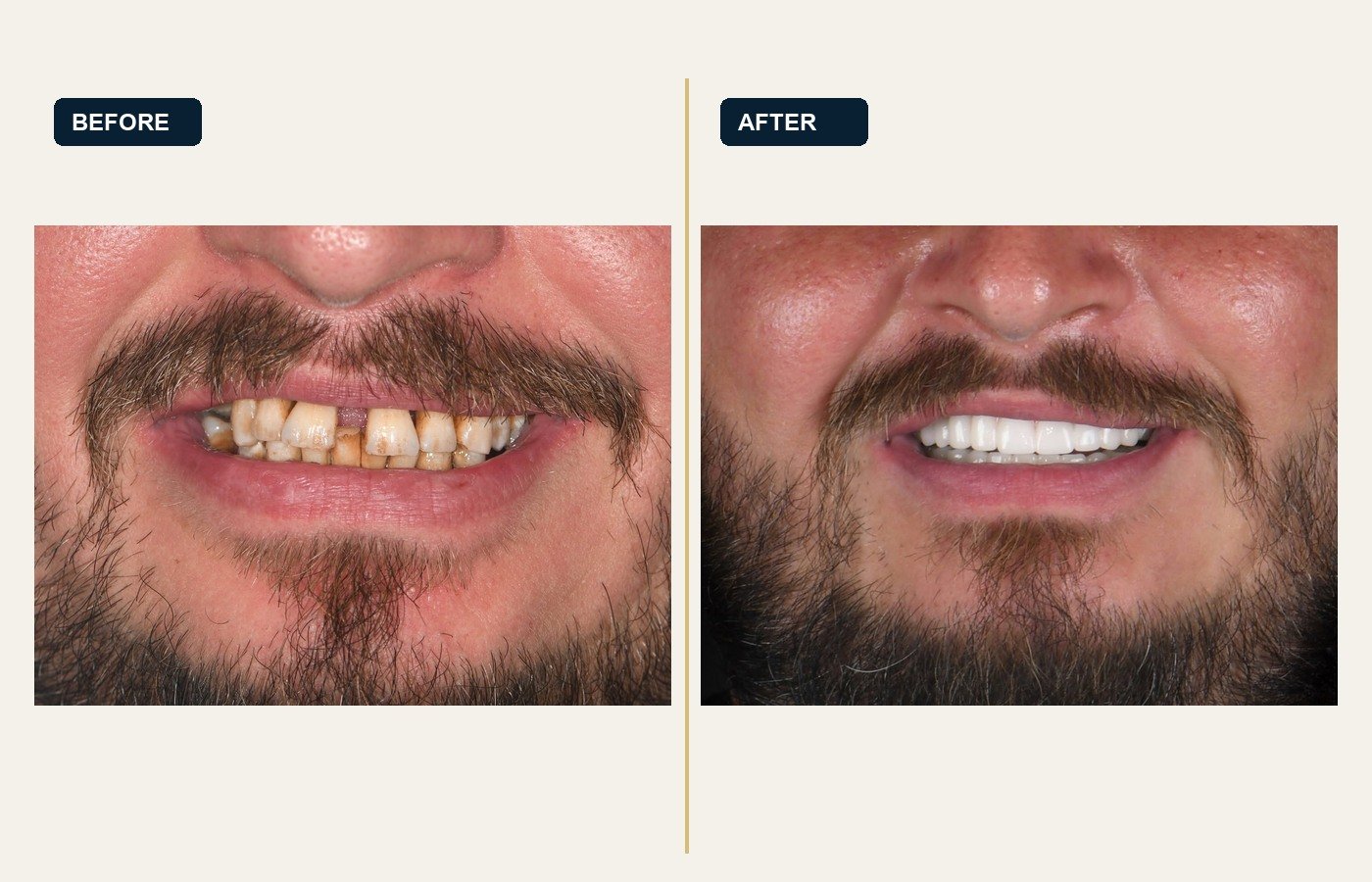 Before After 1