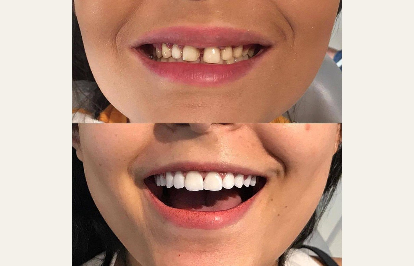 Before After 1