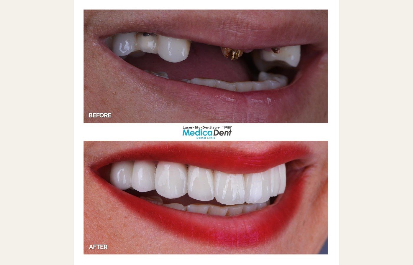 Before After 1
