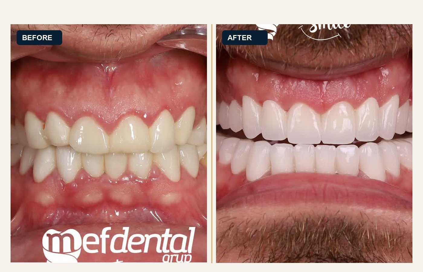 Before After 1