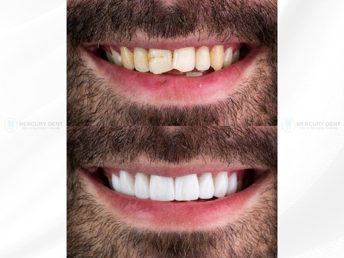 Before After 1