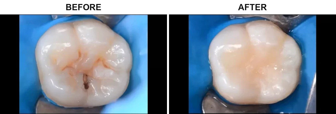 Before After 1