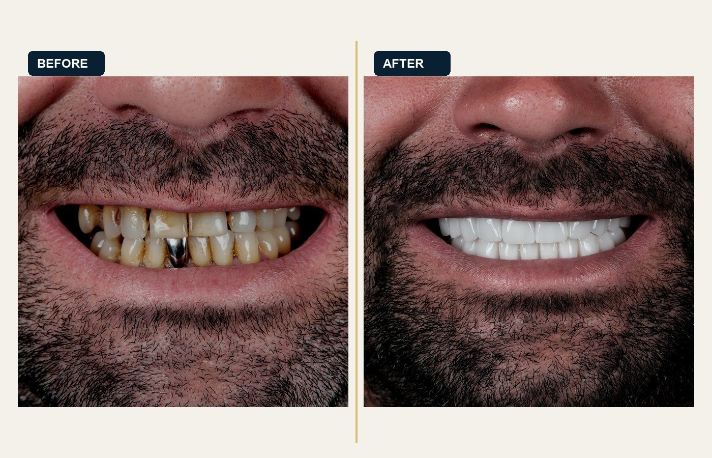 Before After 1