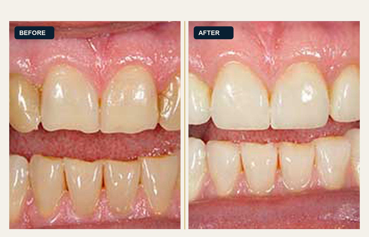 Before After 1