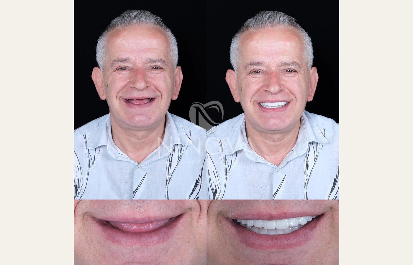 Before After 1