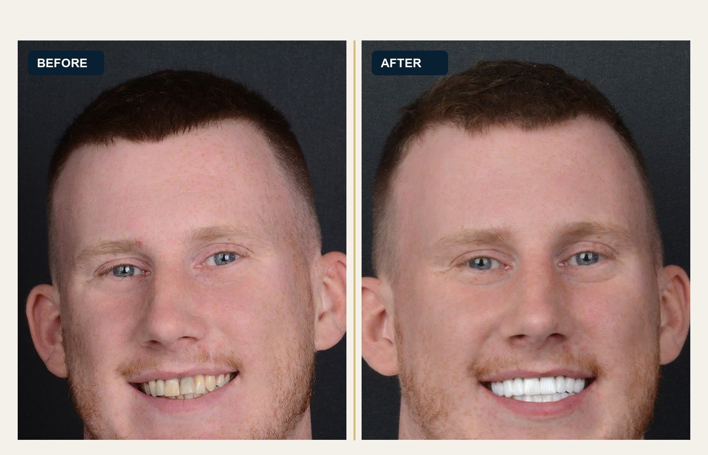 Before After 1