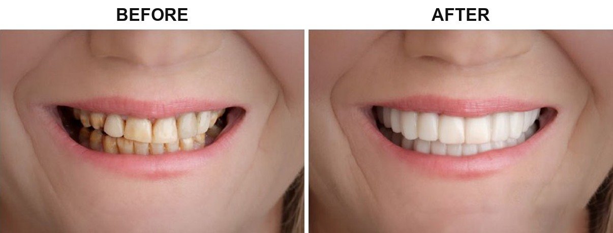 Before After 1