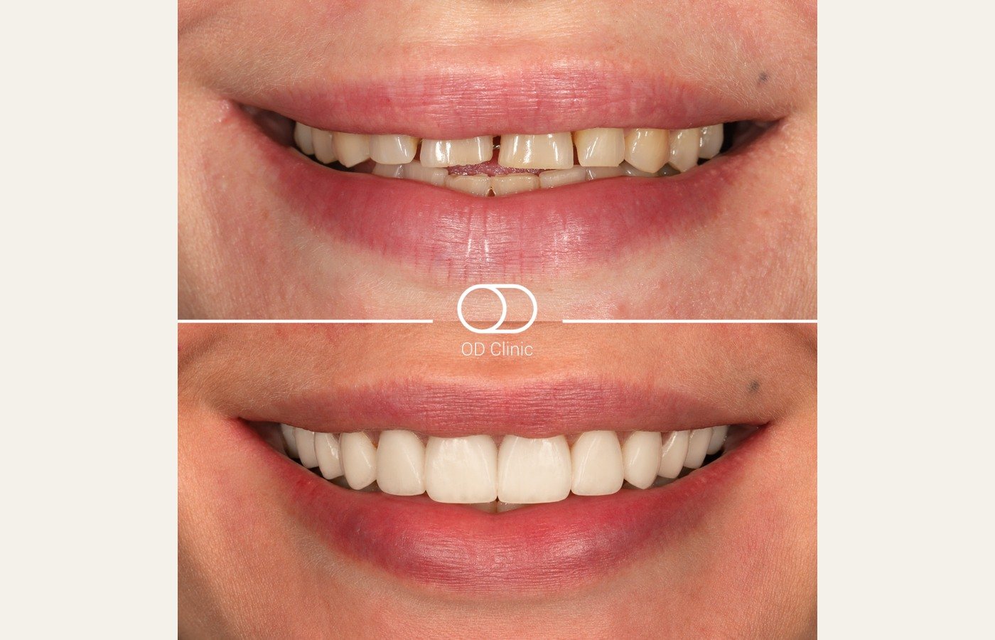 Before After 1