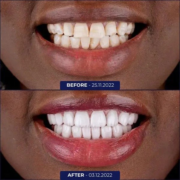 Before After 1