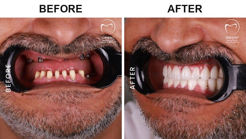 Before After 1