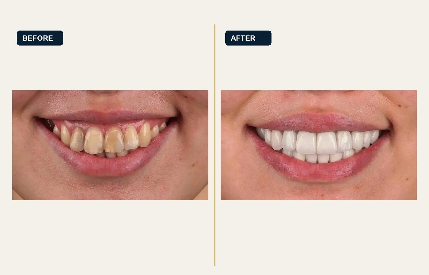 Before After 1
