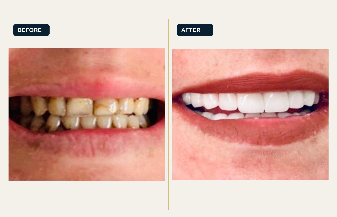 Before After 1