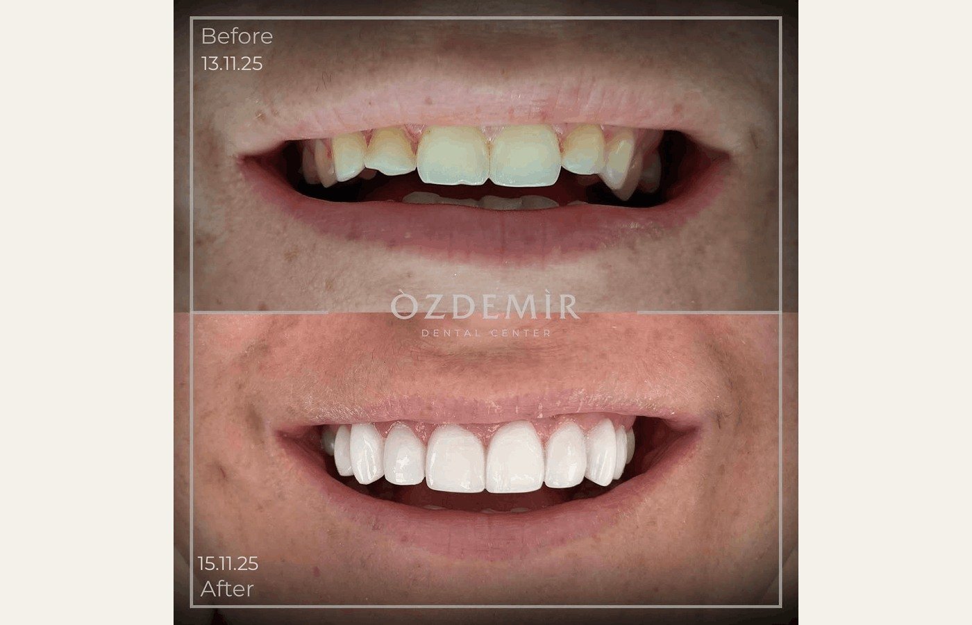 Before After 1