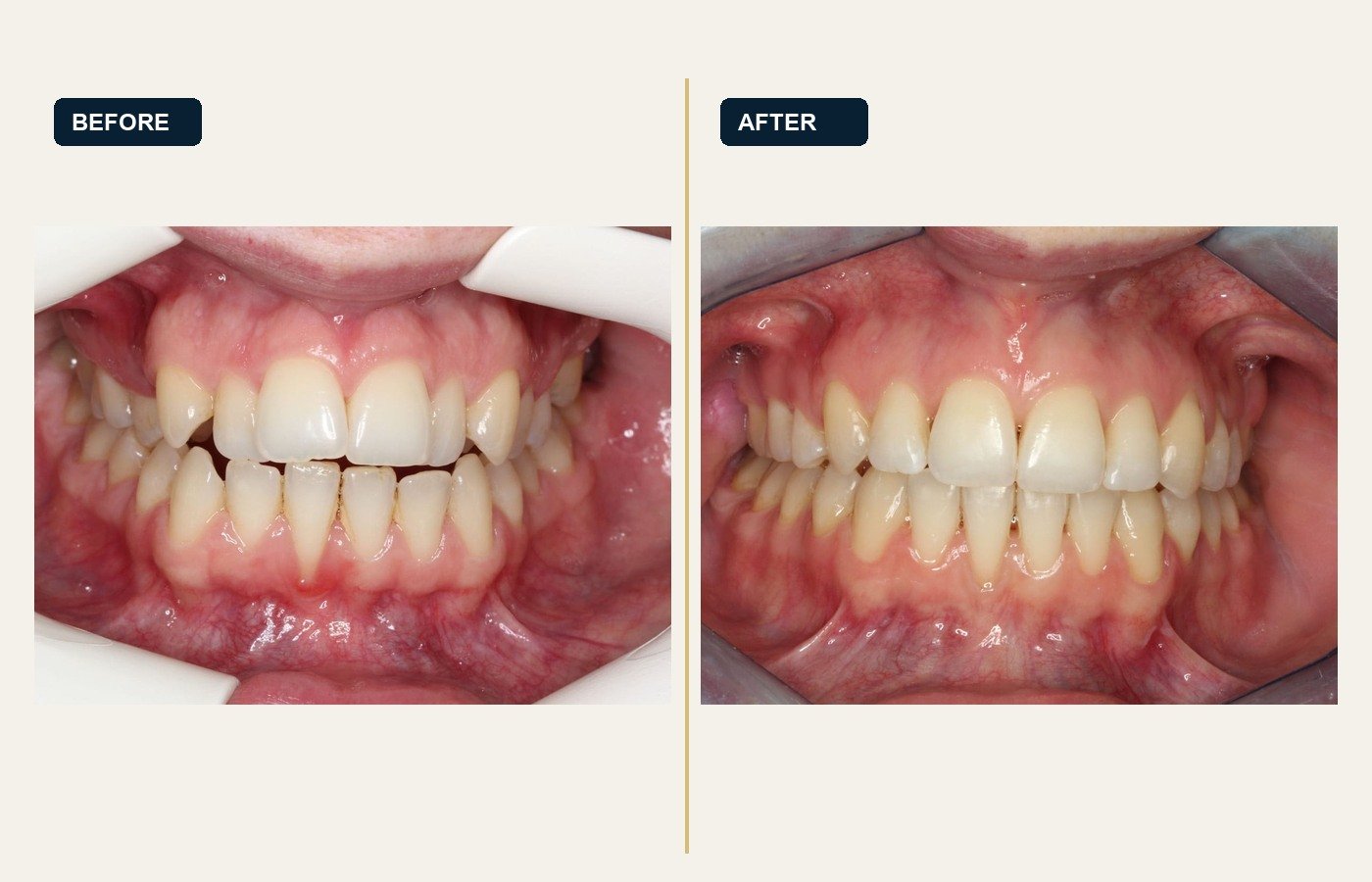 Before After 1