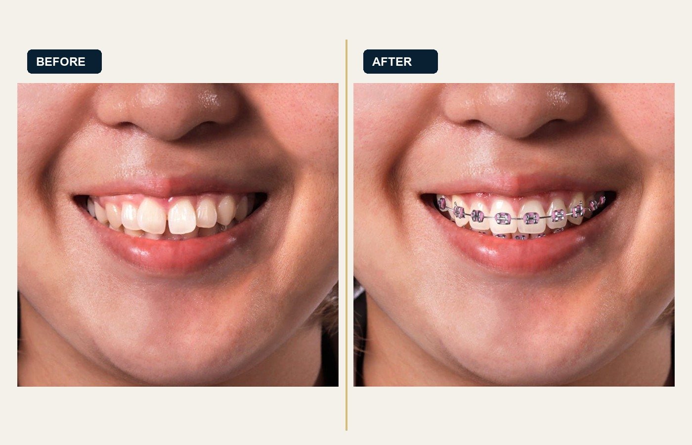 Before After 1