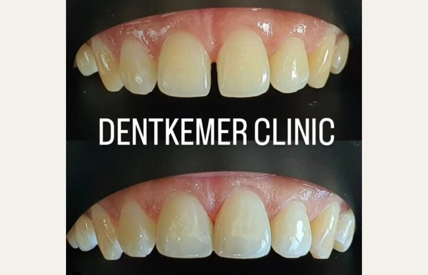 Before After 1