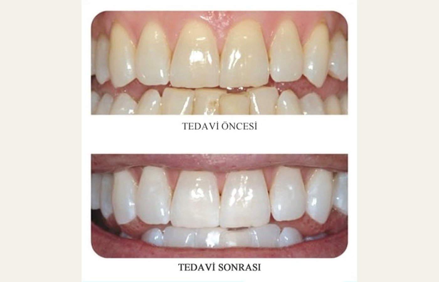 Before After 1