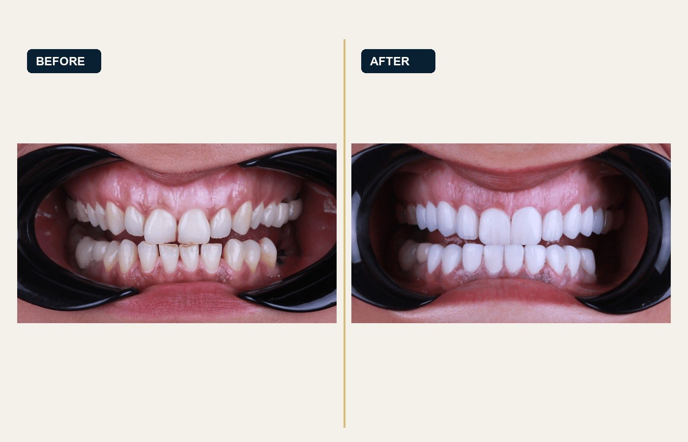 Before After 1