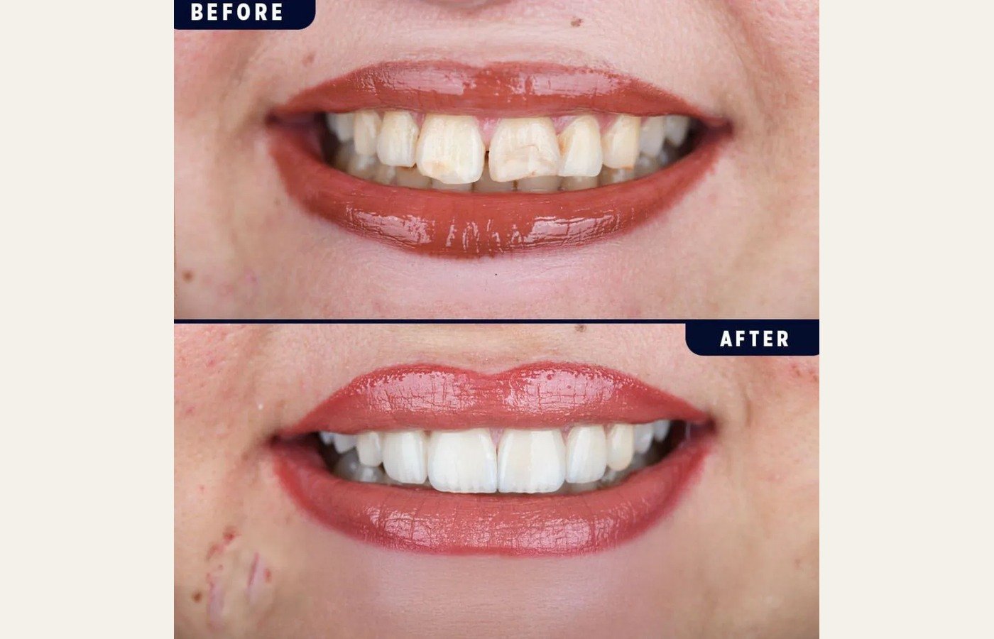 Before After 1