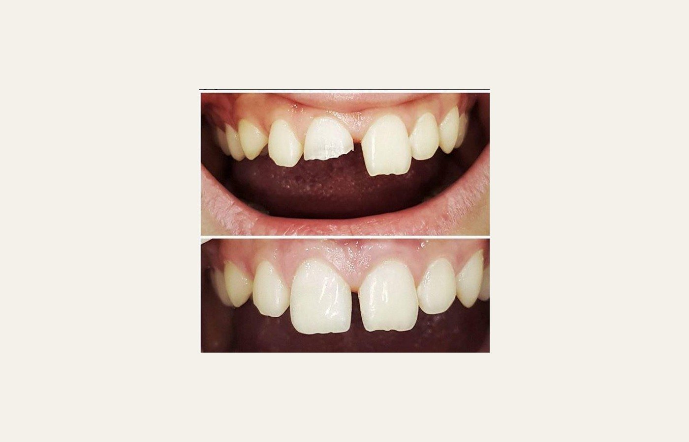 Before After 1