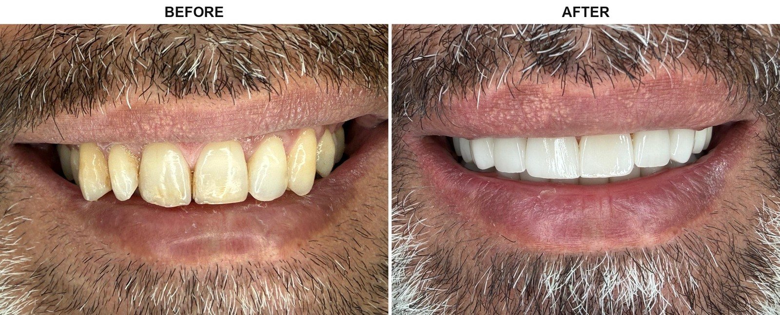Before After 1