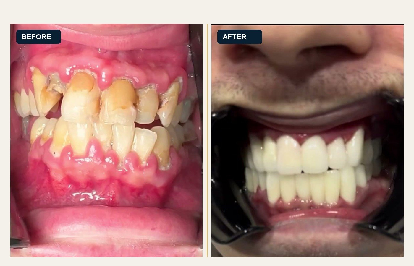 Before After 1