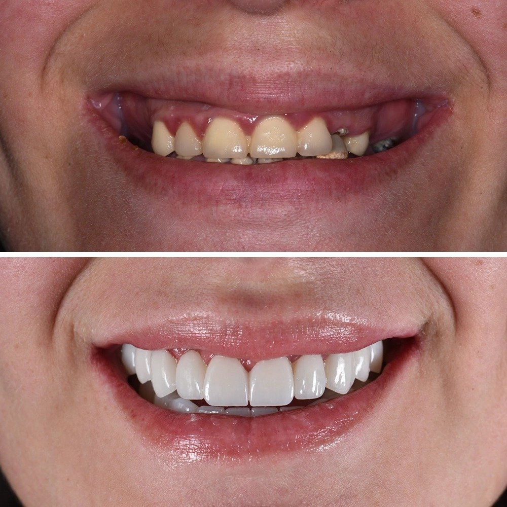 Before After 1