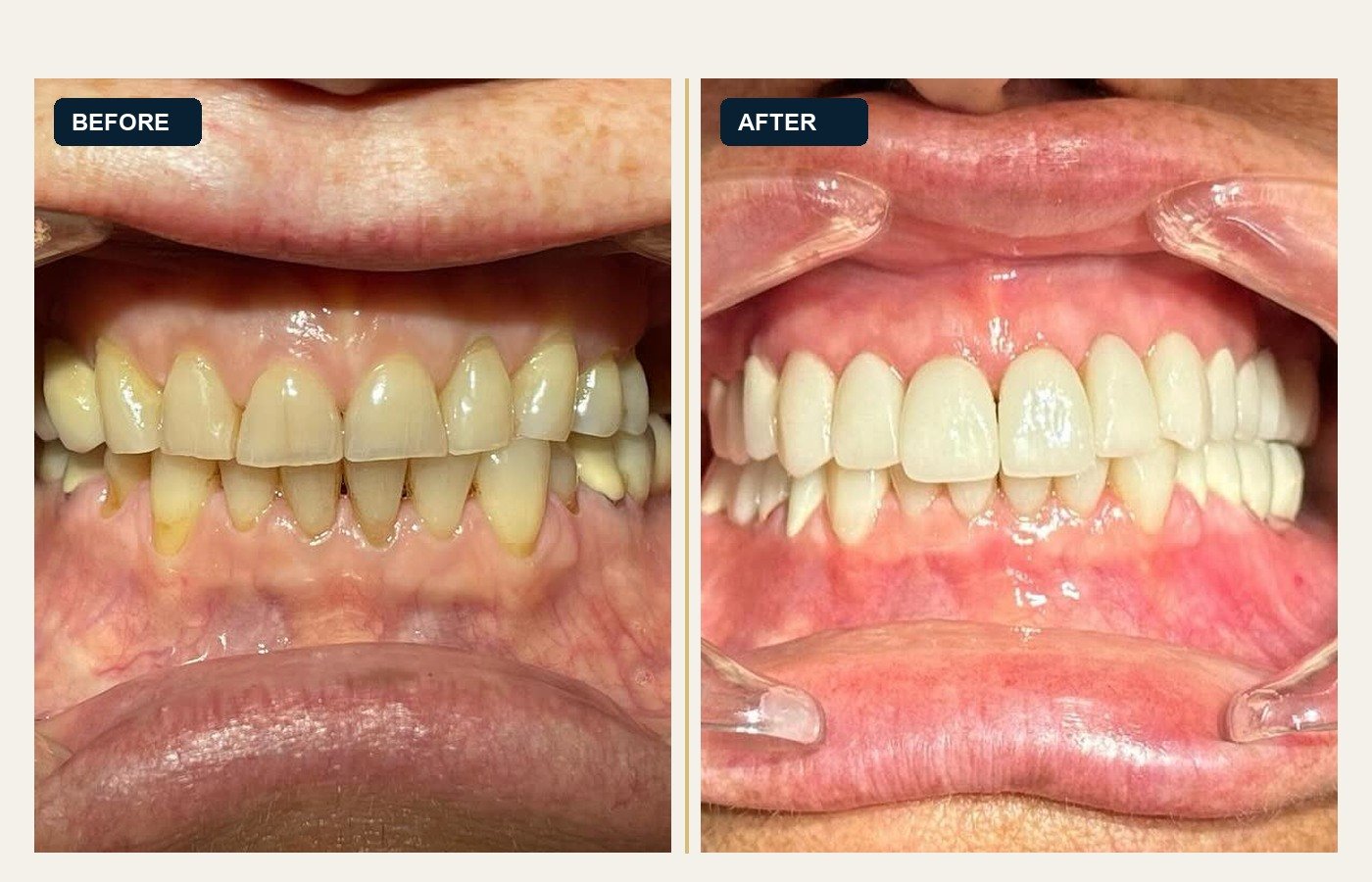 Before After 1