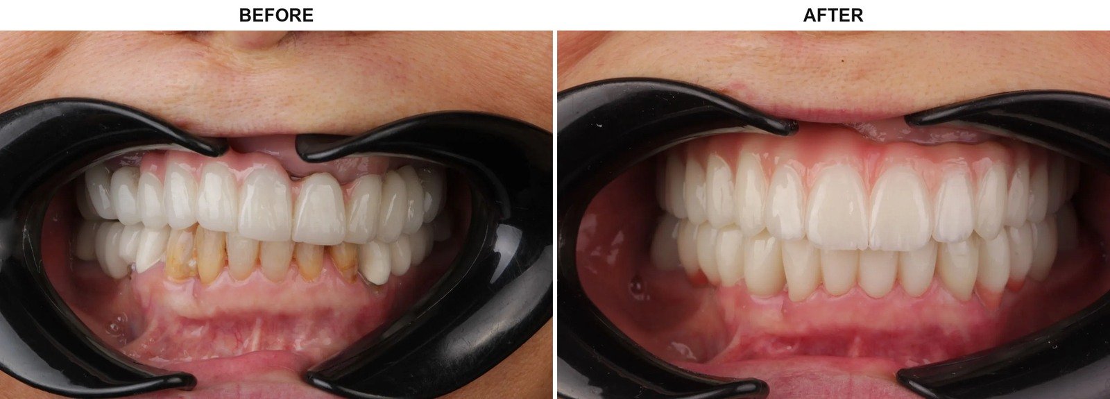 Before After 1