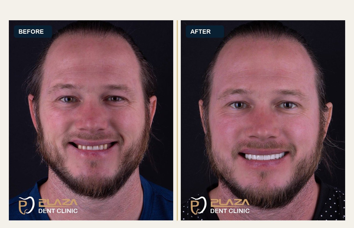 Before After 1