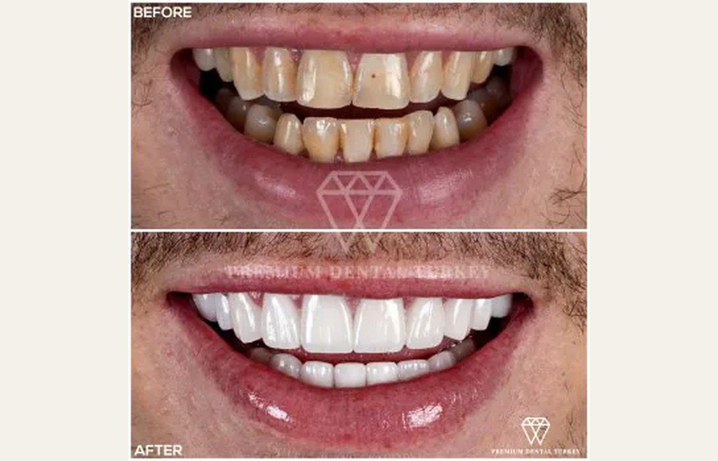 Before After 1