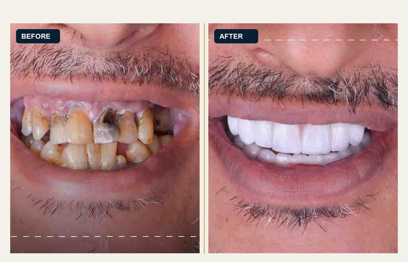 Before After 1