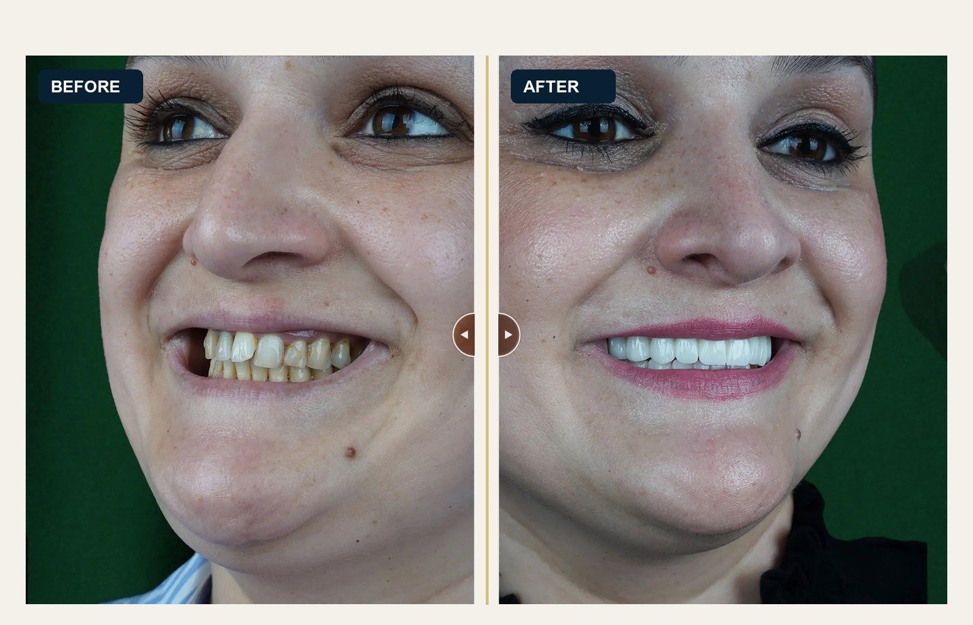 Before After 1