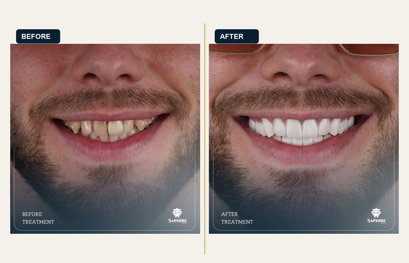 Before After 1