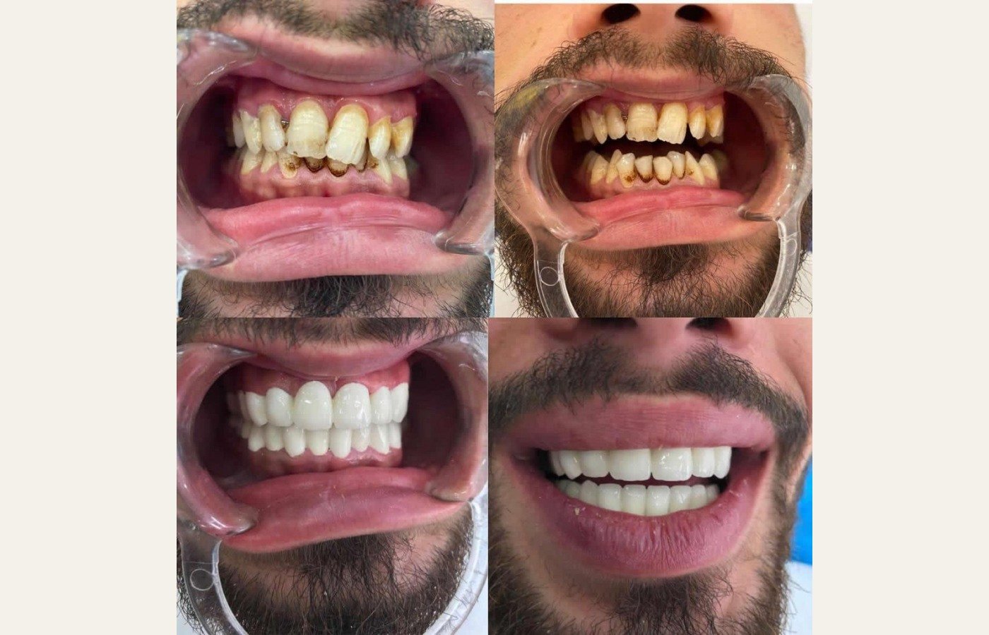 Before After 1