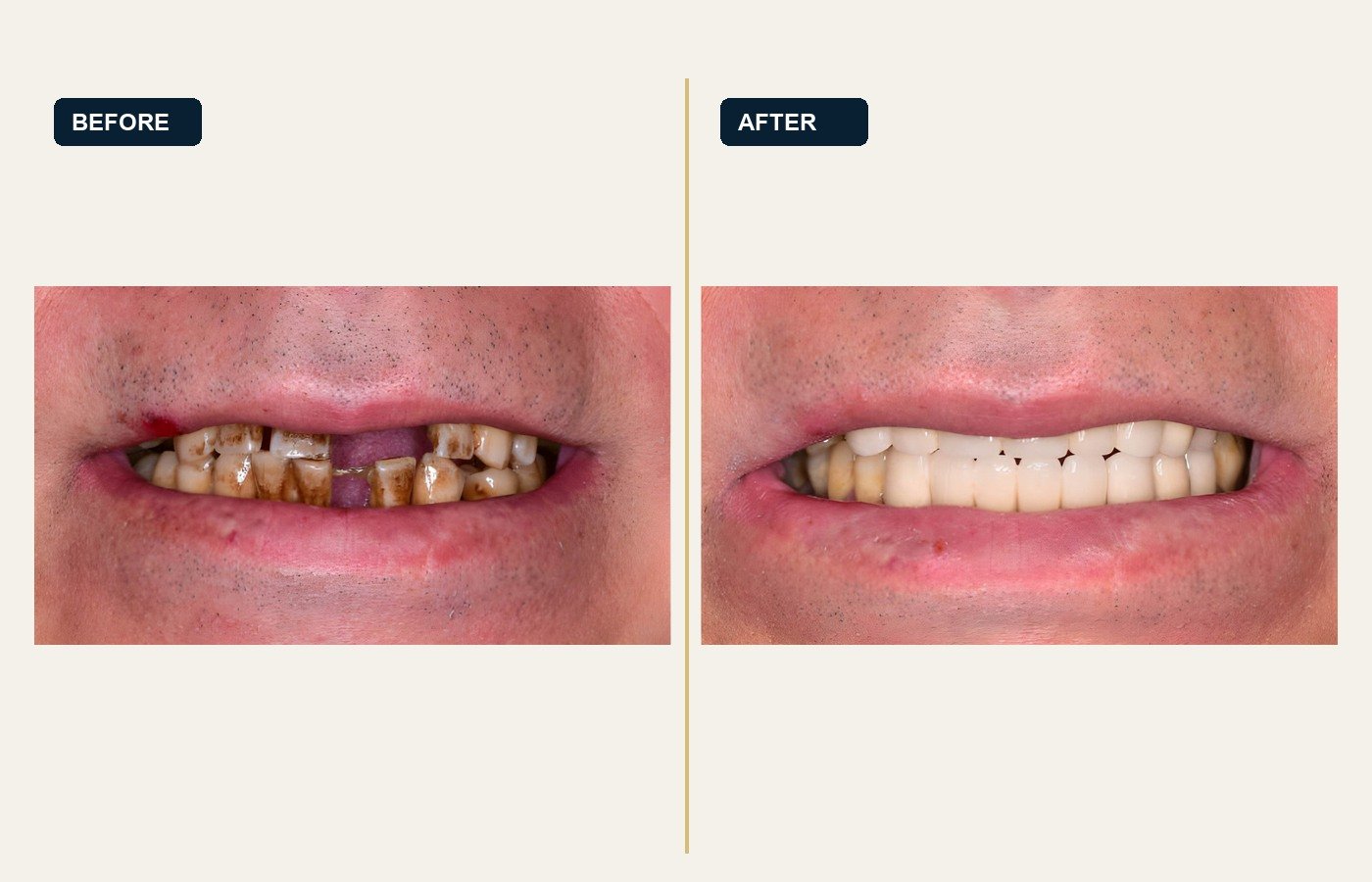 Before After 1