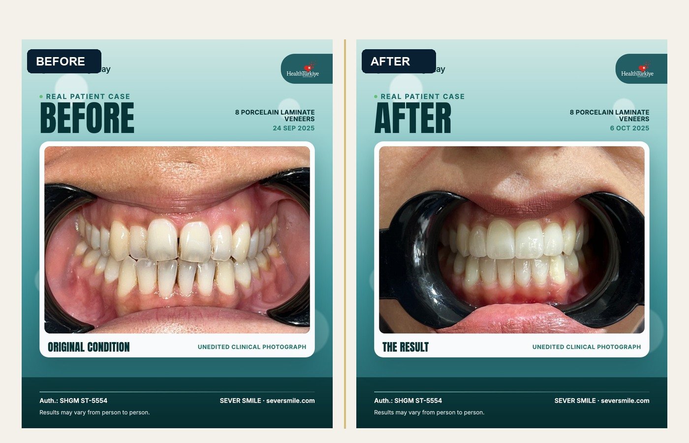 Before After 1