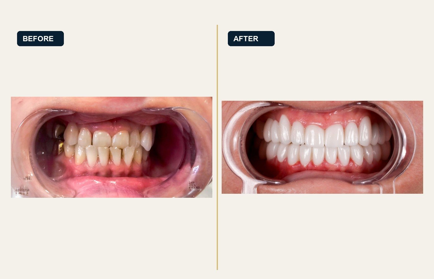 Before After 1