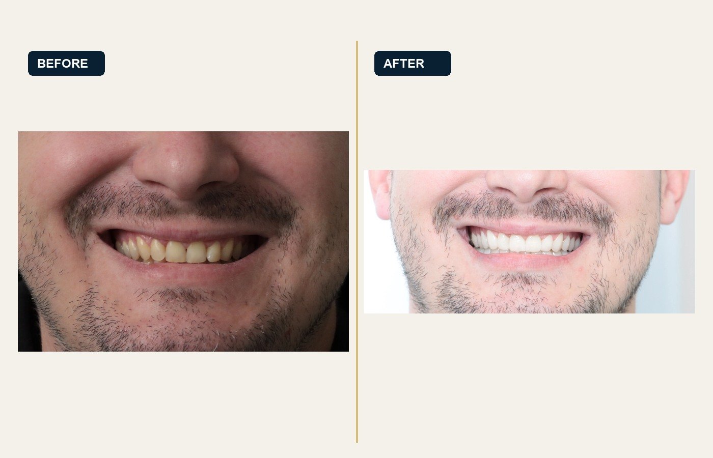 Before After 1
