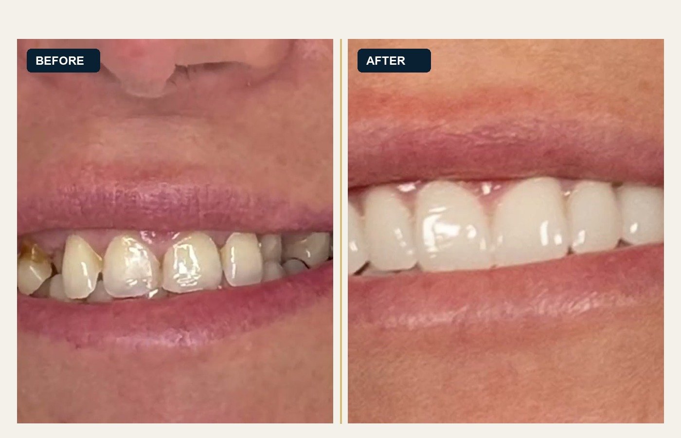 Before After 1