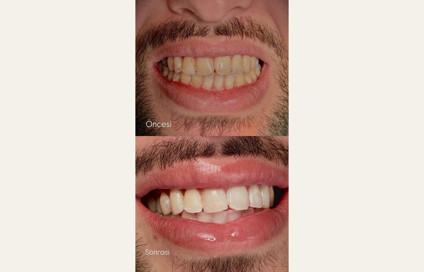 Before After 1