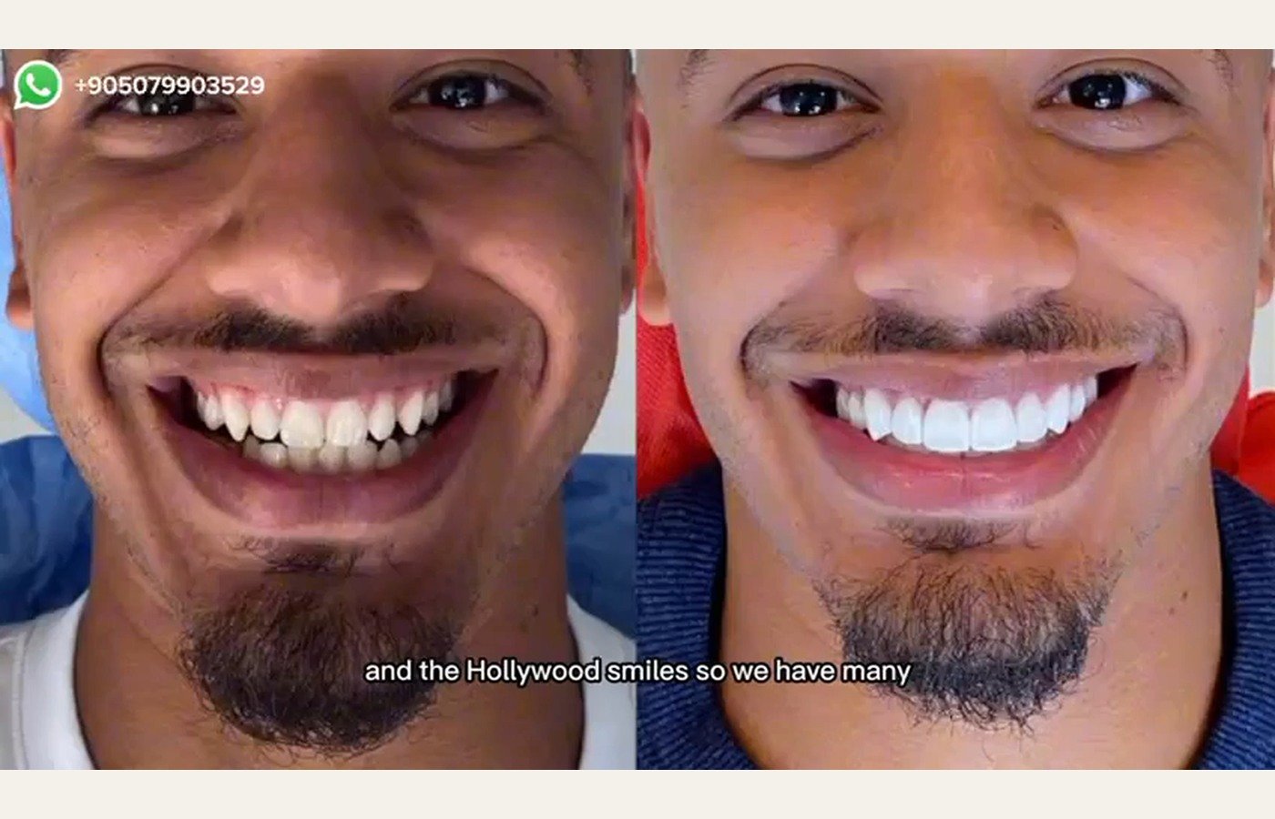 Before After 1