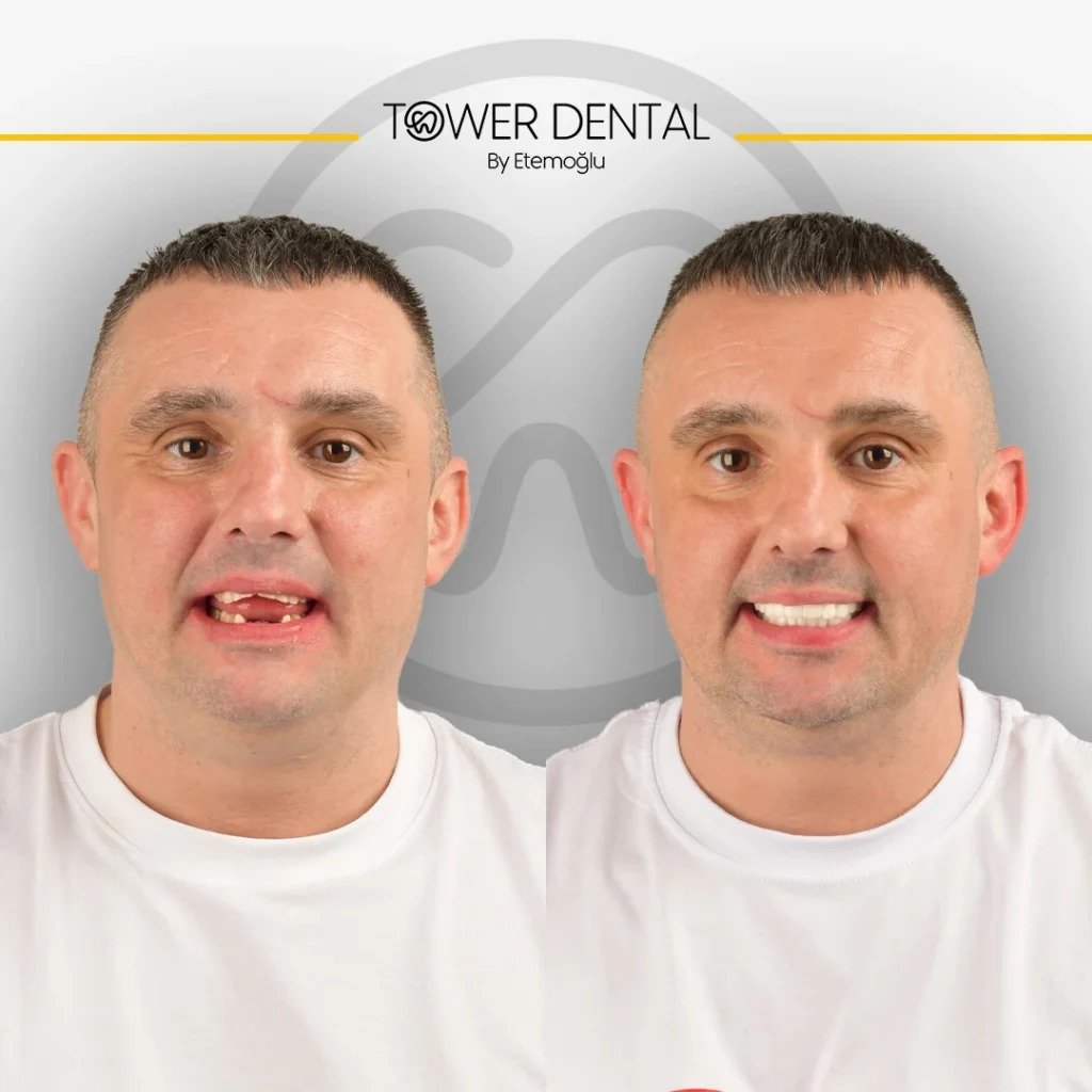 Before After 1