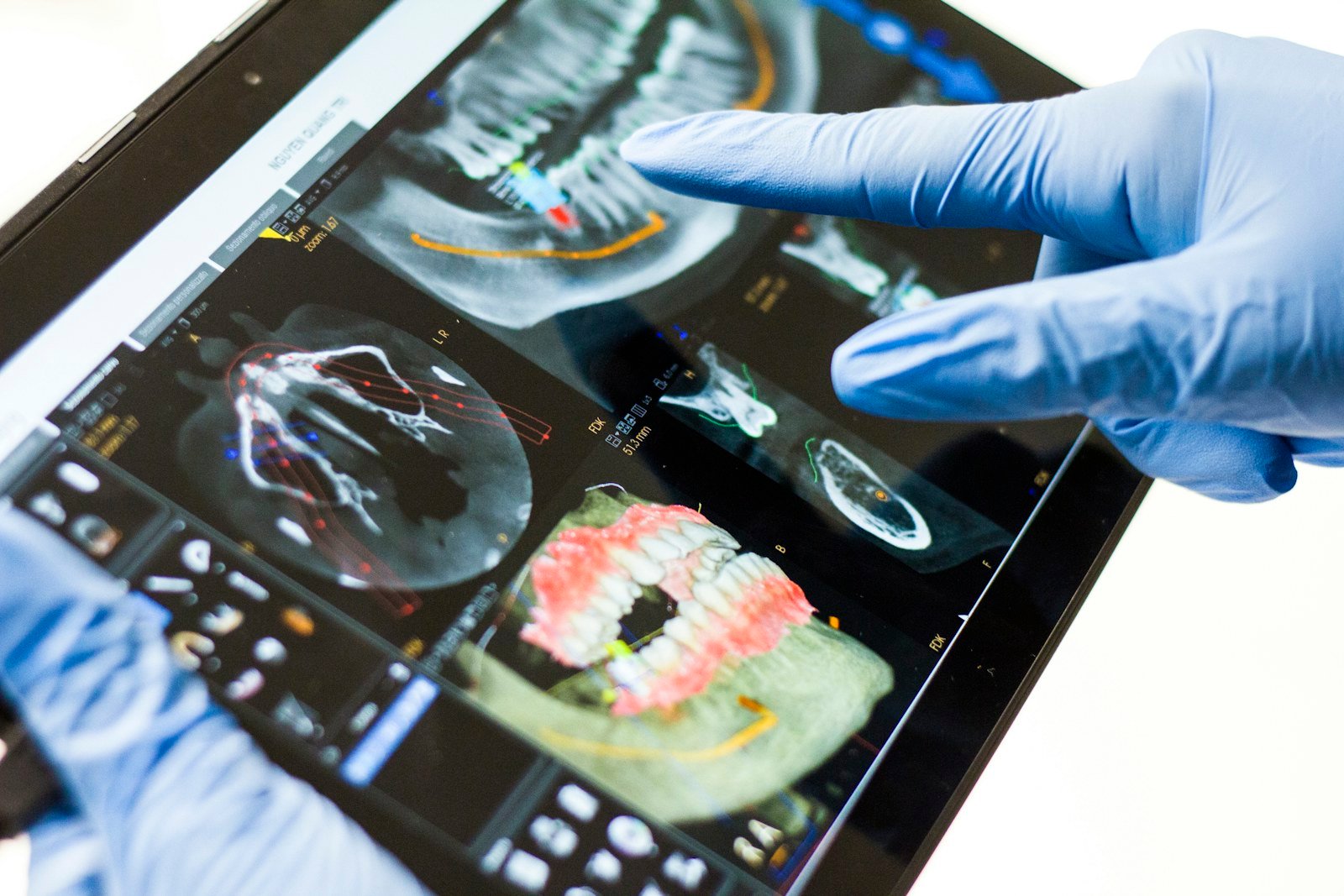 Dentist reviewing a 3D dental scan to diagnose failed crowns and veneers